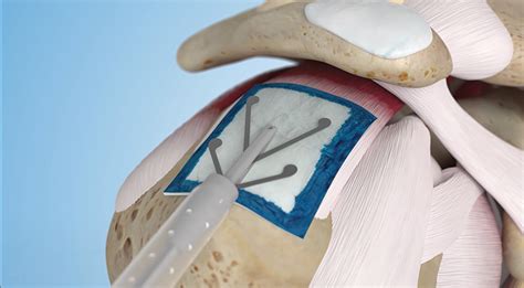 patch saddle nephew|Bioinductive Collagen Implant Augmentation for the Repair of .